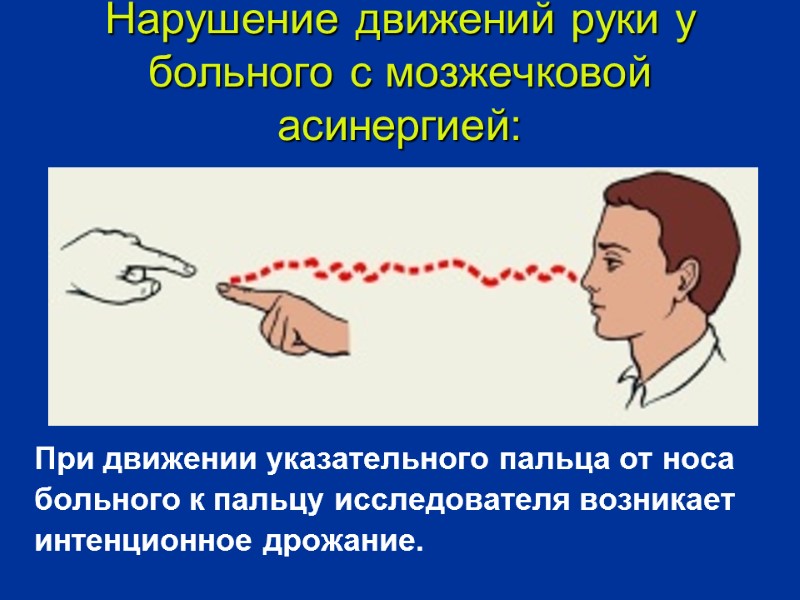 Нарушение движений руки у больного с мозжечковой асинергией: При движении указательного пальца от носа